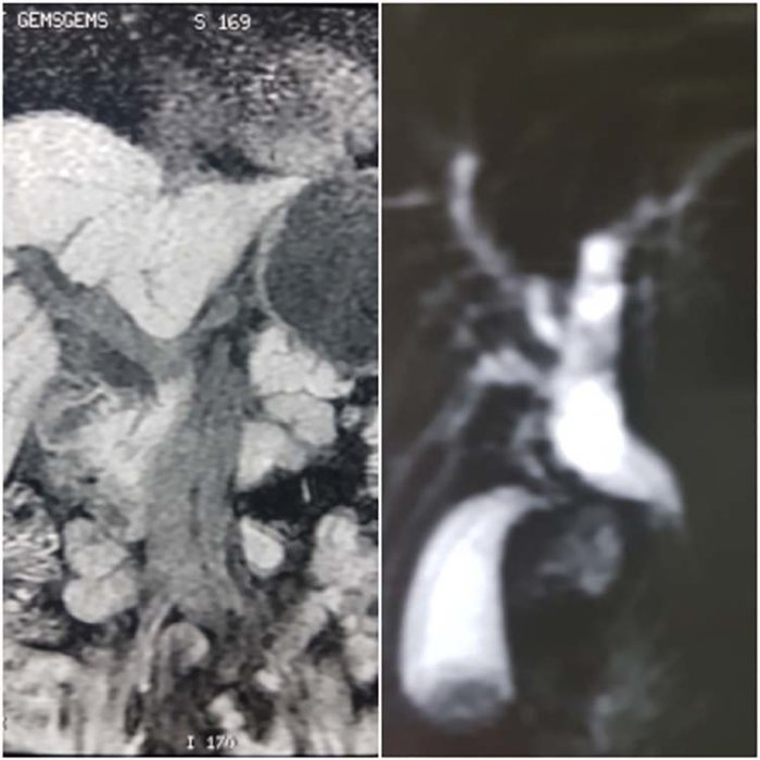 Duct extending superolaterally from the uterus