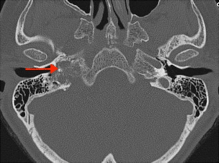 Duct extending superolaterally from the uterus